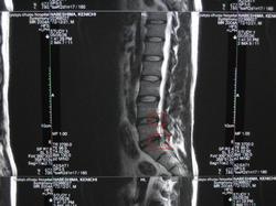椎間板ヘルニア完治後MRI写真